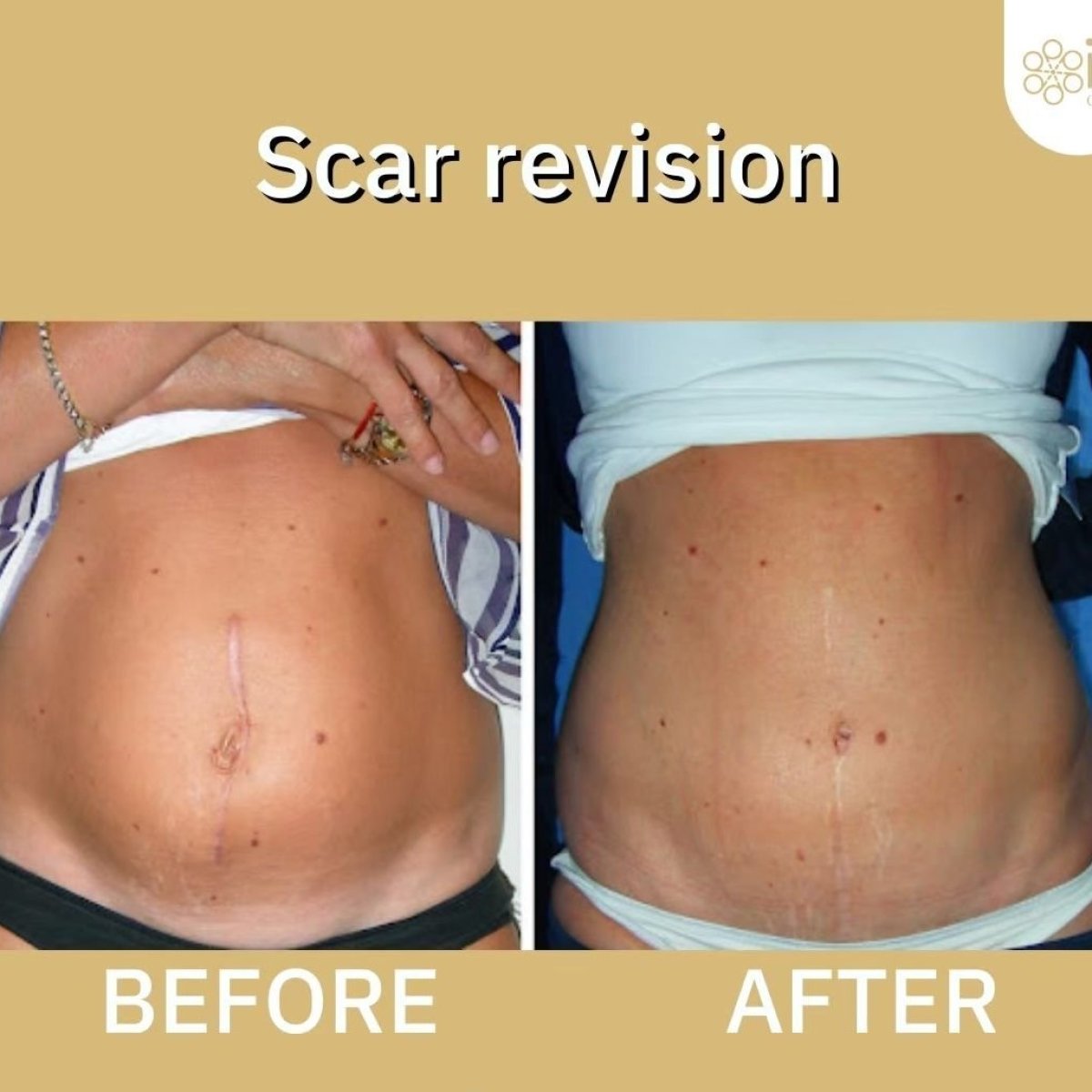 Resultados de antes y después de revisión de cicatriz en ID Clinic Bangkok, abdomen mejorado