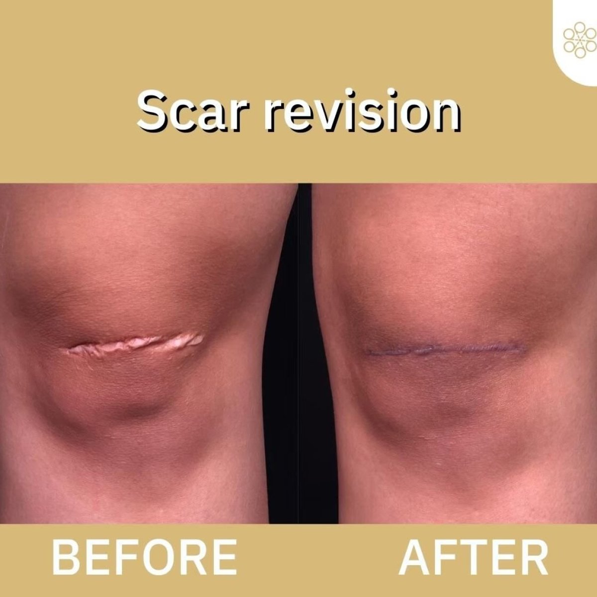 Resultados antes y después de la revisión de cicatriz en rodilla en ID Clinic Bangkok