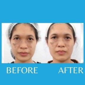 Результаты до и после PRP-терапии для лица при пигментации в ID Clinic Bangkok
