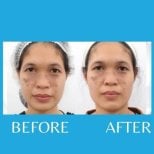 Результаты до и после PRP-терапии для лица при пигментации в ID Clinic Bangkok