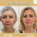 Resultados de lifting facial AccuTite antes y después en ID Clinic Bangkok, rejuvenecimiento visible