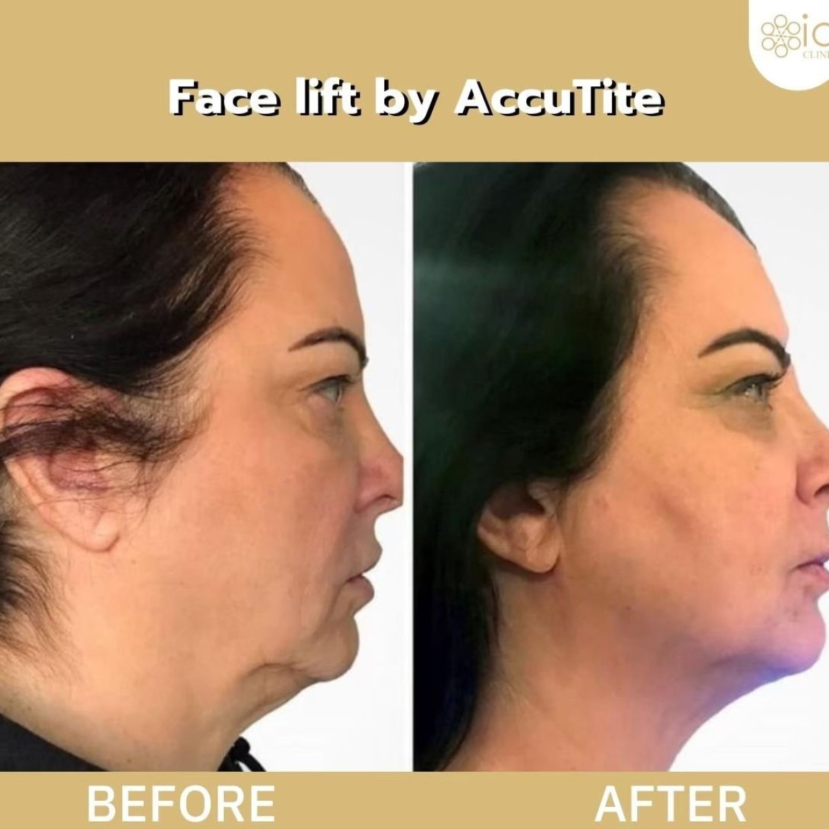 Vorher-nachher-Ergebnis AccuTite Facelift bei ID Clinic Bangkok, sichtbare Kieferstraffung