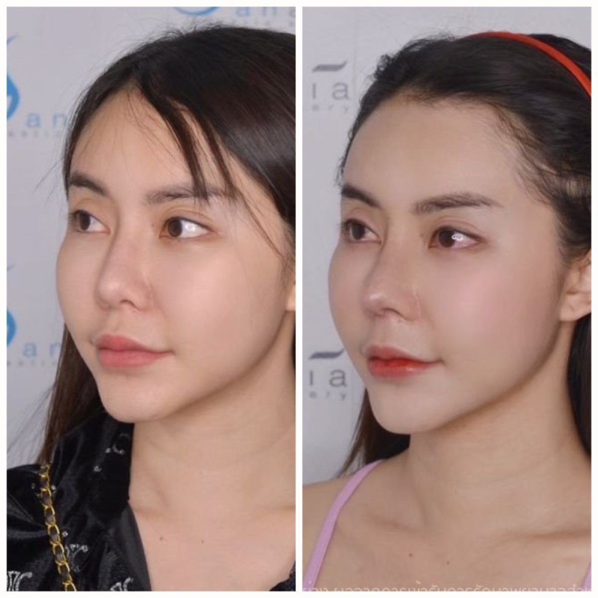 Resultados de rinoplastia antes y después en Janasia Clinic, remodelación nasal natural