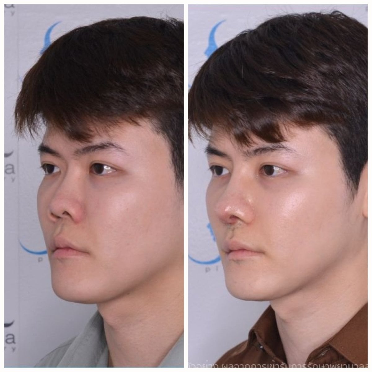 نتائج عملية تجميل الأنف قبل وبعد في Janasia Clinic، تحسين شكل الأنف لدى رجل