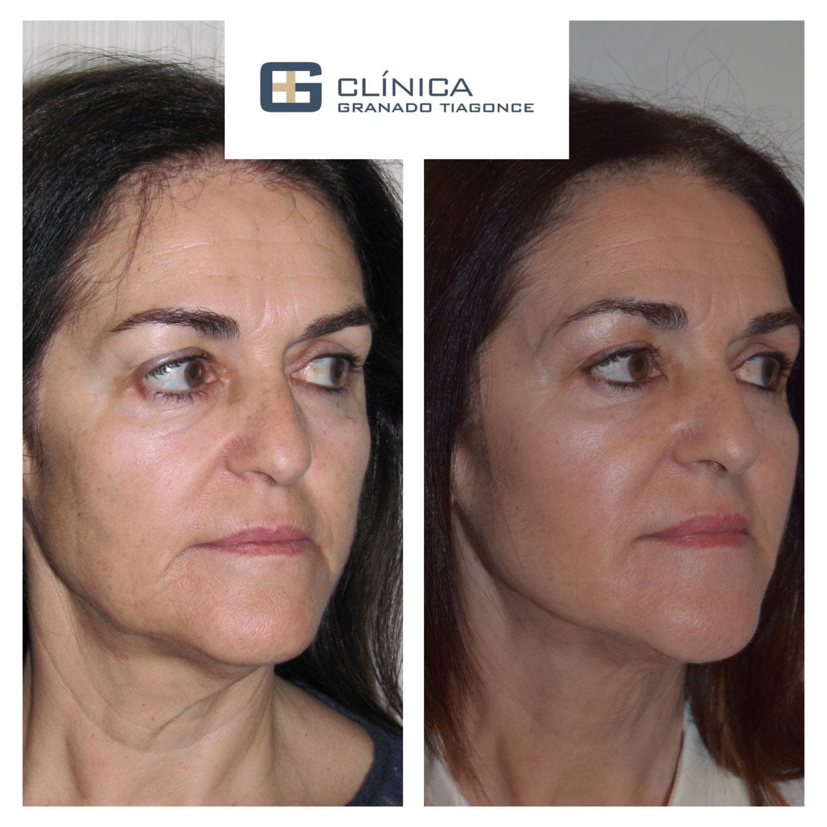 Resultados de lipofilling facial antes y después en Clinica Granado Tiagonce, rejuvenecimiento visible