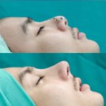 Vorher-nachher-Ergebnis der offenen Rhinoplastik bei The SiB Plastic Surgery, verbesserte Nasenform