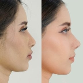 Vorher-nachher-Ergebnisse der offenen Rhinoplastik bei The SiB Plastic Surgery, verbesserte Nasenform