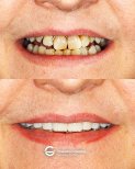 Vorher-nachher-Ergebnisse Zahnimplantat bei Tommaso Grandi Dental Clinic, verbesserte Ästhetik