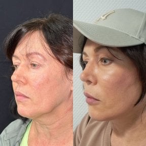 Before and after neck lift results at Dr. Safa Manav Clinic, visible jawline and neck contour