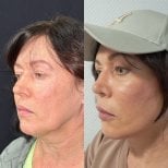 Before and after neck lift results at Dr. Safa Manav Clinic, visible jawline and neck contour