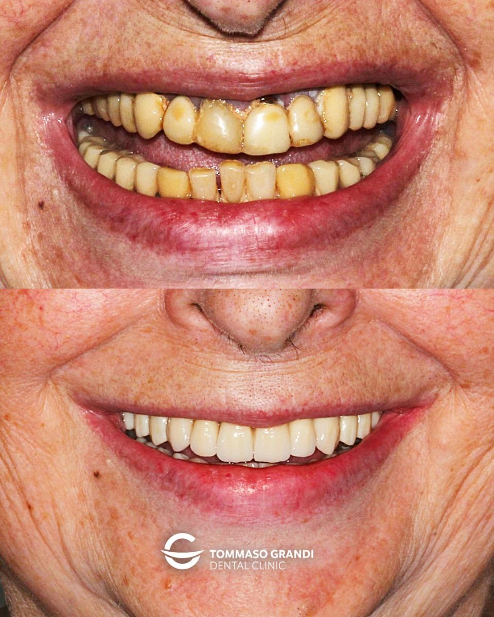 Résultat avant/après prothèses fixes zircone à Tommaso Grandi Dental Clinic