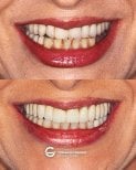 Resultados antes y después de prótesis fijas de zirconia en Tommaso Grandi Dental Clinic