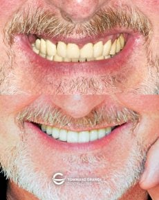 Resultado antes y después de prótesis fija de zirconia sobre implantes en Tommaso Grandi Dental Clinic
