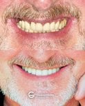 Resultado antes y después de prótesis fija de zirconia sobre implantes en Tommaso Grandi Dental Clinic