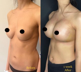 Vorher-nachher-Ergebnis Brustimplantat-Revision bei Dr. Safa Manav Clinic, 1 Woche post-op