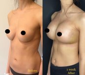 Vorher-nachher-Ergebnis Brustimplantat-Revision bei Dr. Safa Manav Clinic, 1 Woche post-op