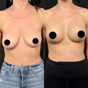 Vorher-nachher-Ergebnis Brustimplantat-Revision in der Dr. Safa Manav Klinik, verbesserte Form