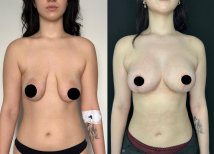 Vorher-nachher-Ergebnis Brustimplantat-Revision in der Dr. Safa Manav Klinik, verbesserte Form