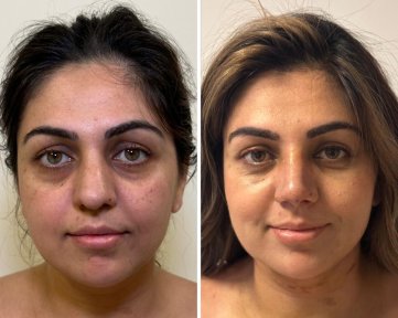 Vorher-nachher-Ergebnis Halsstraffung bei Dr. Safa Manav Clinic, sichtbare Verjüngung