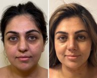 Vorher-nachher-Ergebnis Halsstraffung bei Dr. Safa Manav Clinic, sichtbare Verjüngung