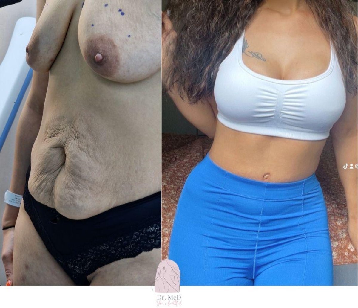 Vorher-nachher-Ergebnis Mommy Makeover bei Dr. MED – Brust- und Bauchkontur verbessert