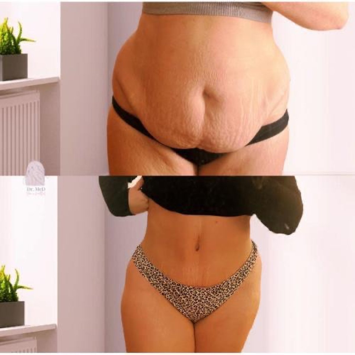 Vorher-nachher Mommy Makeover bei Dr. MED – sichtbare Bauchkontur Ergebnisse