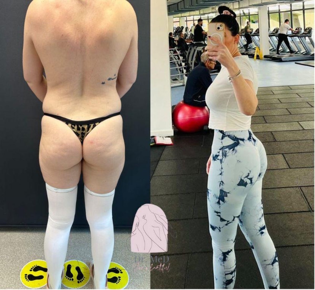Antes y después de implantes de glúteos en Dr. MED – mejor contorno y forma
