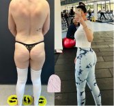 Before and after butt implants at Dr. MED – enhanced gluteal contour and shape result