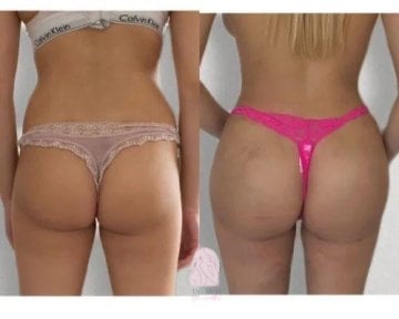 Before and after butt implants at Dr. MED – enhanced gluteal contour and volume result