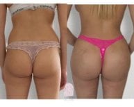 Before and after butt implants at Dr. MED – enhanced gluteal contour and volume result