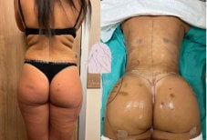 Before and after butt implants at Dr. MED – enhanced buttock shape and volume result