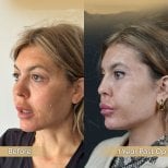 Vorher-nachher-Ergebnis Mini-Facelift bei Dr. Safa Manav Clinic, sichtbare Verjüngung