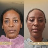 Vorher-nachher-Ergebnis Mini-Facelift bei Dr. Safa Manav Clinic, sichtbare Verjüngung