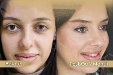 Mini-Facelift Vorher-Nachher-Ergebnis bei Dr. Safa Manav Clinic, sichtbare Verjüngung