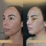 Mini-Facelift Vorher-Nachher-Ergebnisse in der Dr. Safa Manav Klinik, sichtbare Konturveränderung