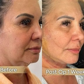 Before and after neck lift results at Dr. Safa Manav Clinic, visible jawline improvement