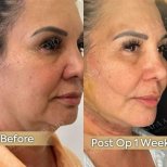 Before and after neck lift results at Dr. Safa Manav Clinic, visible jawline improvement