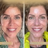 Neck lift before and after results at Dr. Safa Manav Clinic, visible rejuvenation after 4 months