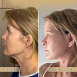 Before and after neck lift results at Dr. Safa Manav Clinic, visible jawline and neck tightening