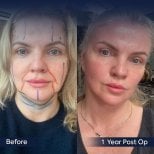 Before and after neck lift results at Dr. Safa Manav Clinic, visible jawline and neck contour