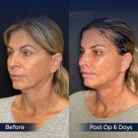 Before and after neck lift results at Dr. Safa Manav Clinic, visible neck contour improvement