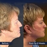Before and after neck lift results at Dr. Safa Manav Clinic, visible jawline improvement