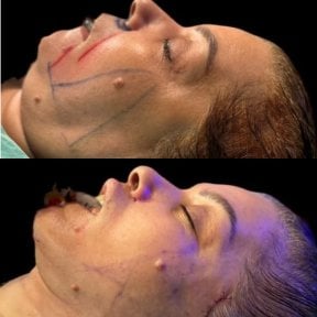 Before and after neck lift results at Dr. Safa Manav Clinic, visible jawline improvement