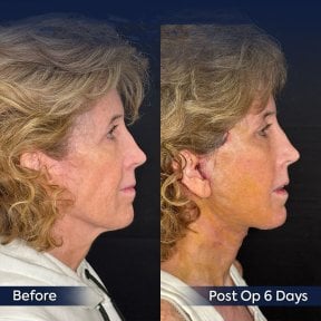 Before and after neck lift results at Dr. Safa Manav Clinic, visible neck contour improvement