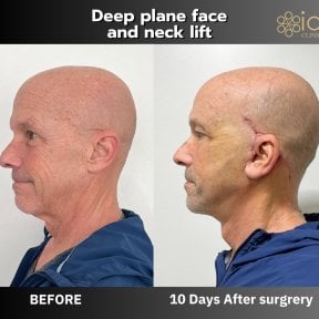 Resultados de lifting de cuello antes y después en ID Clinic Bangkok, rejuvenecimiento visible