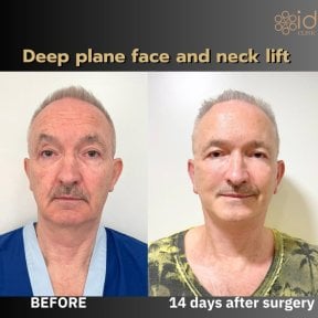 Vorher-nachher-Ergebnis Deep Plane Face- und Necklift bei ID Clinic Bangkok, 14 Tage post-op