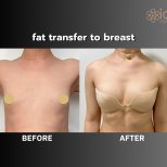 Before and after breast augmentation with fat transfer results at ID Clinic Bangkok