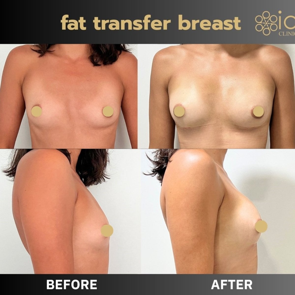 Resultados de aumento de senos con transferencia de grasa antes y después en ID Clinic Bangkok