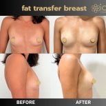 Before and after breast augmentation with fat transfer results at ID Clinic Bangkok