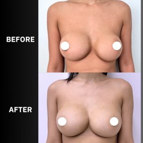 Before and after breast augmentation with fat transfer results at ID Clinic Bangkok